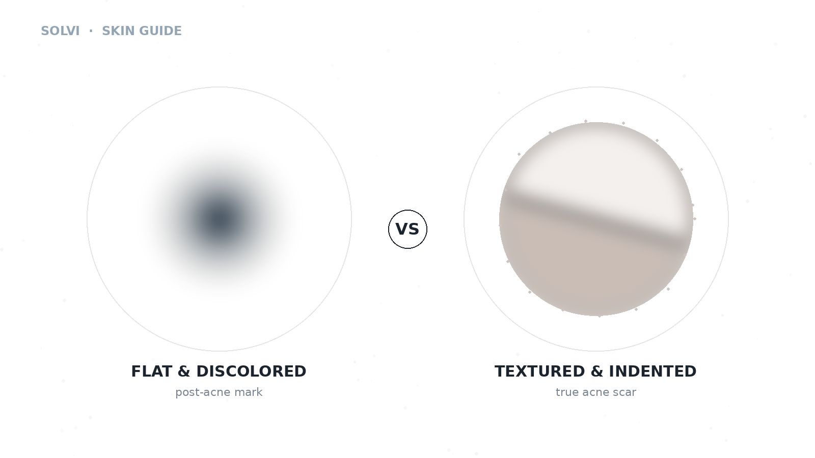 Acne Marks vs. Acne Scars: How to Tell the Difference and What Can Help cover